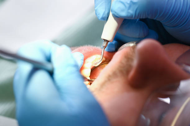 Best Emergency Dentist for Lost Fillings or Crowns in Larimore, ND