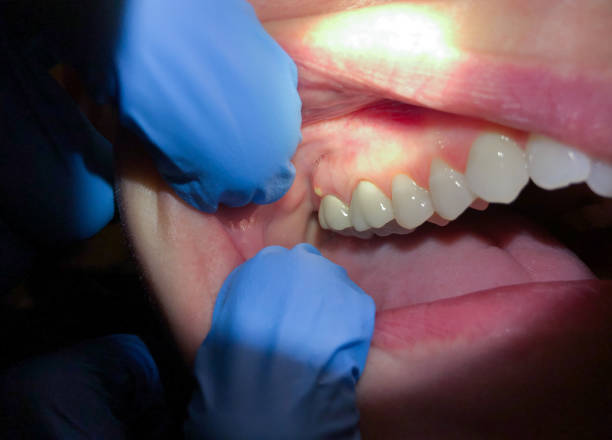 Best Emergency Dental Care for Abscessed Tooth in Larimore, ND